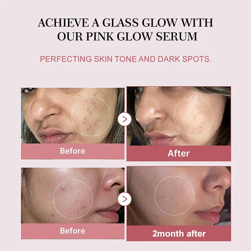 Korean Anti-Acne Serum with Peptides & PDRN — Refined Pores & Even Skin Tone