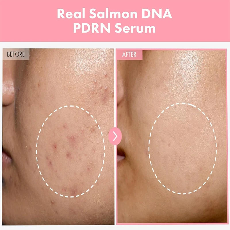 Korean Anti-Acne Serum with Peptides & PDRN — Refined Pores & Even Skin Tone