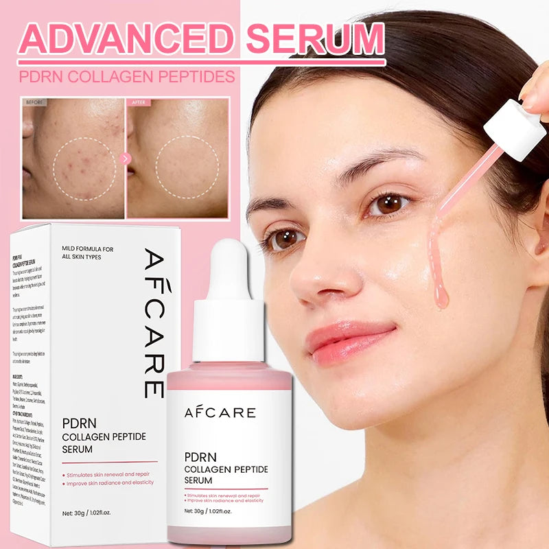 Korean Anti-Acne Serum with Peptides & PDRN — Refined Pores & Even Skin Tone